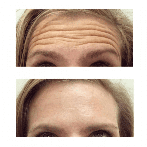 אישה מראה את הקמטים במצח לפני ואחרי הטיפול