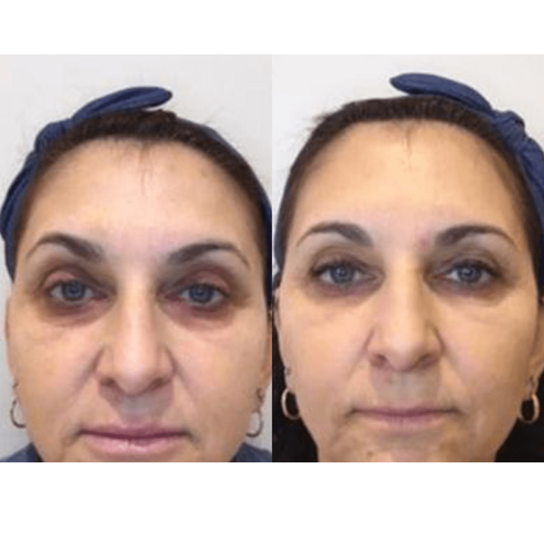 אישהמראה לפני ואחרי טיפול במילוי קמטים